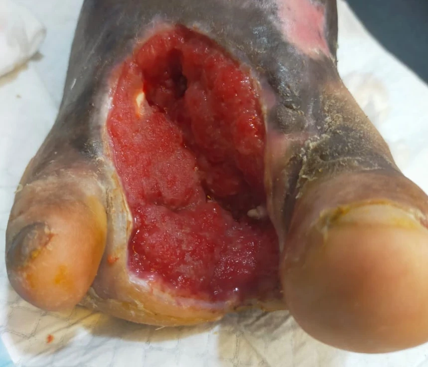 Ulser kaki pada pesakit diabetes — pandangan dokumentasi 1