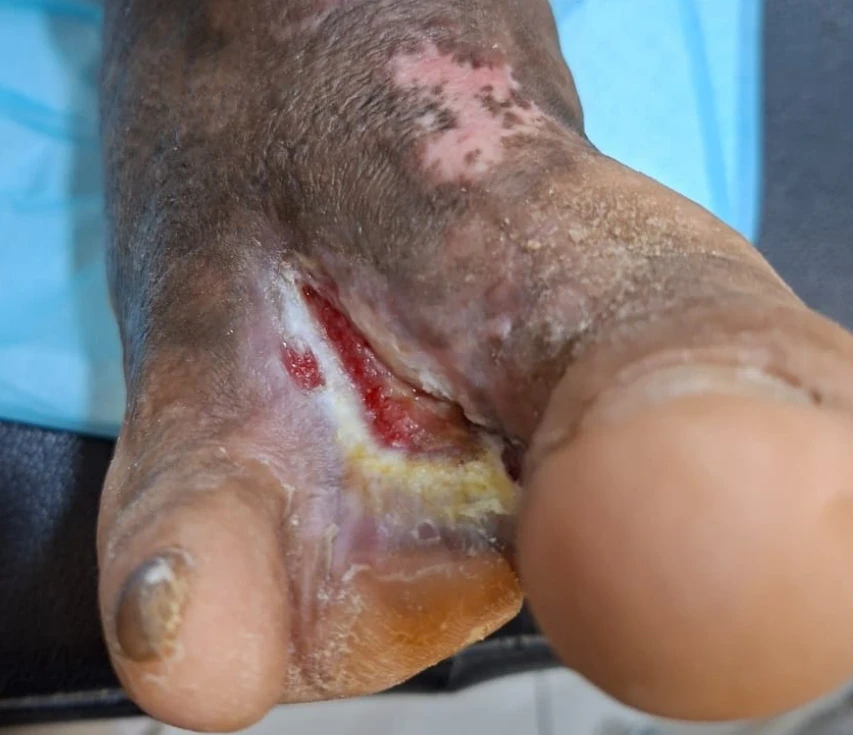 Ulser kaki pada pesakit diabetes — pandangan dokumentasi 2