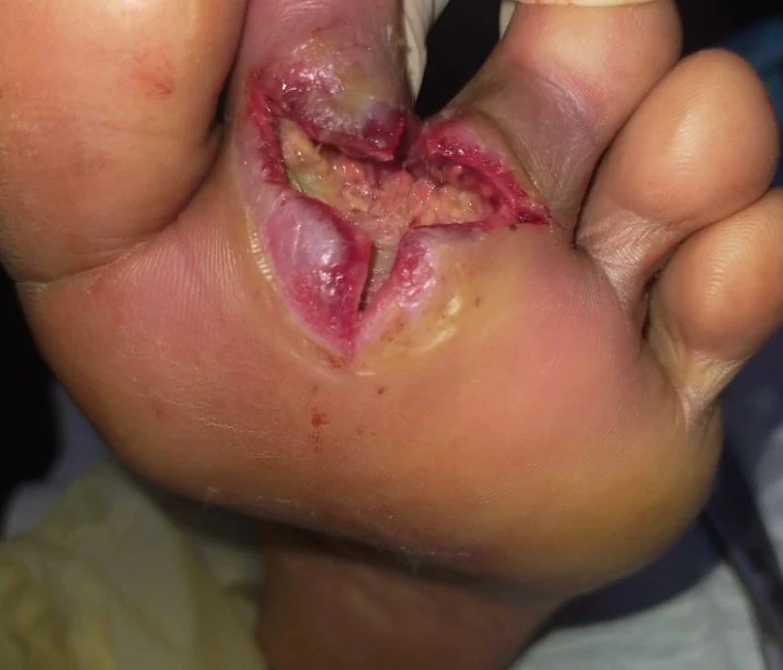 Abses pada kaki — pandangan dokumentasi 1