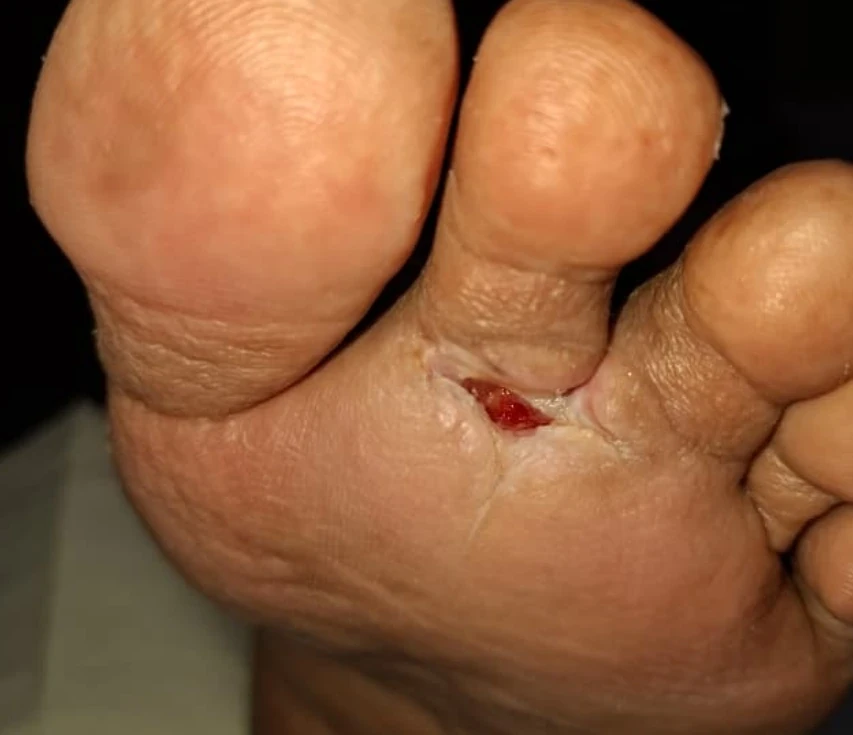 Abses pada kaki — pandangan dokumentasi 2
